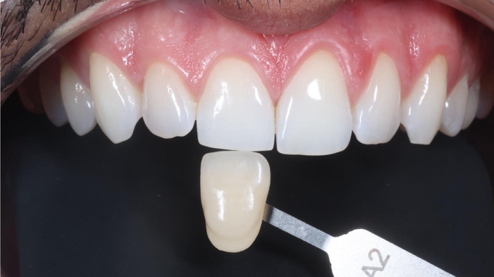 Après éclaircissement dentaire