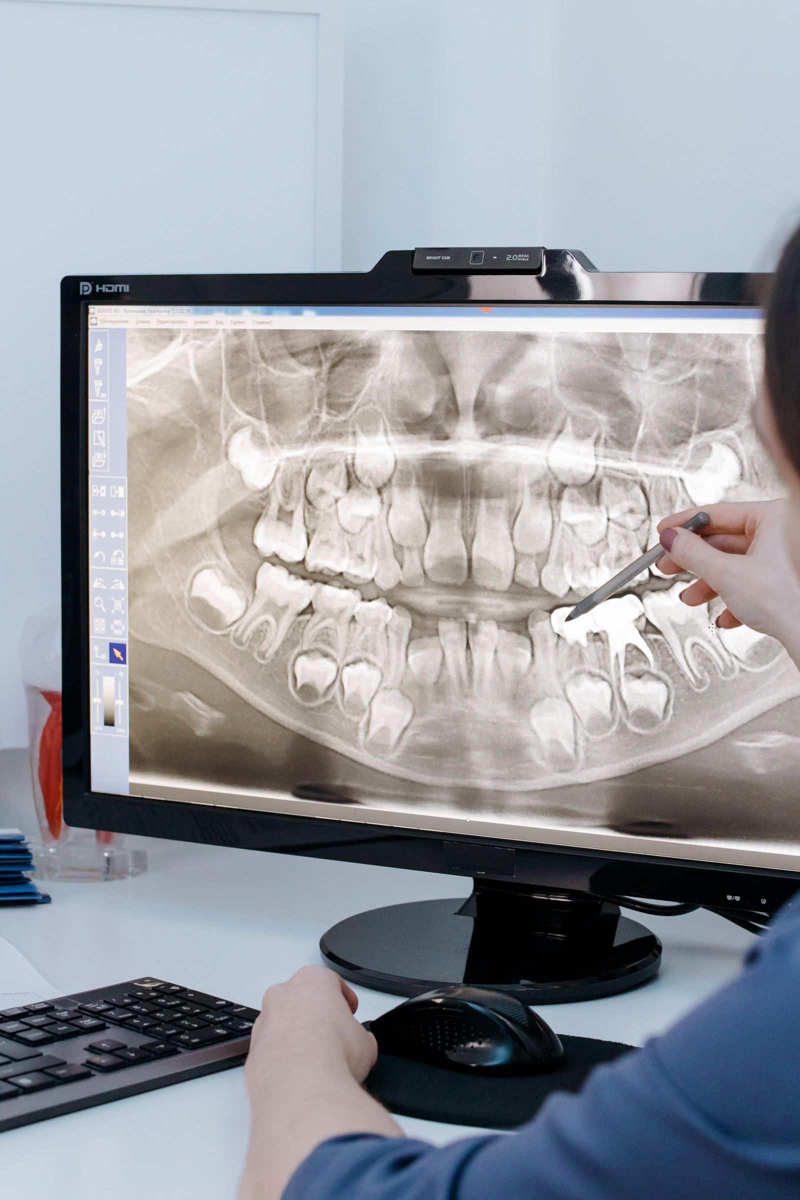 Greffes Osseuses — Wilson Dental