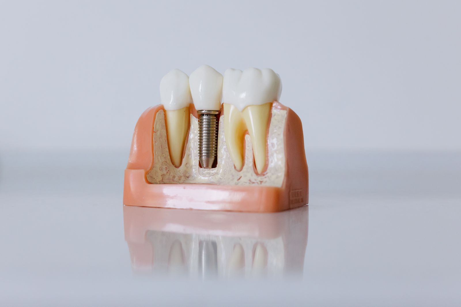 Implants Dentaires — Wilson Dental