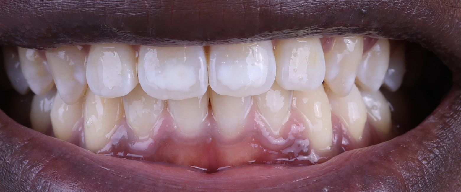 Sourire avant traitement : taches blanches visibles sur les incisives